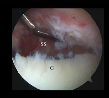 L=Labrum, SS= Subscapularis Muscle, G = Glenoid