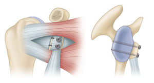Laterjet-Bristow procedure