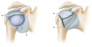 Neer technique of inferior capsular shift