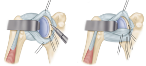 Open Bankart procedure