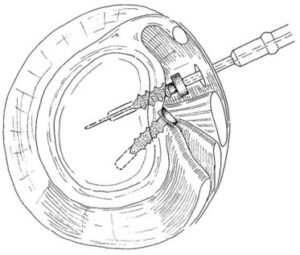bioabsorbable tacks