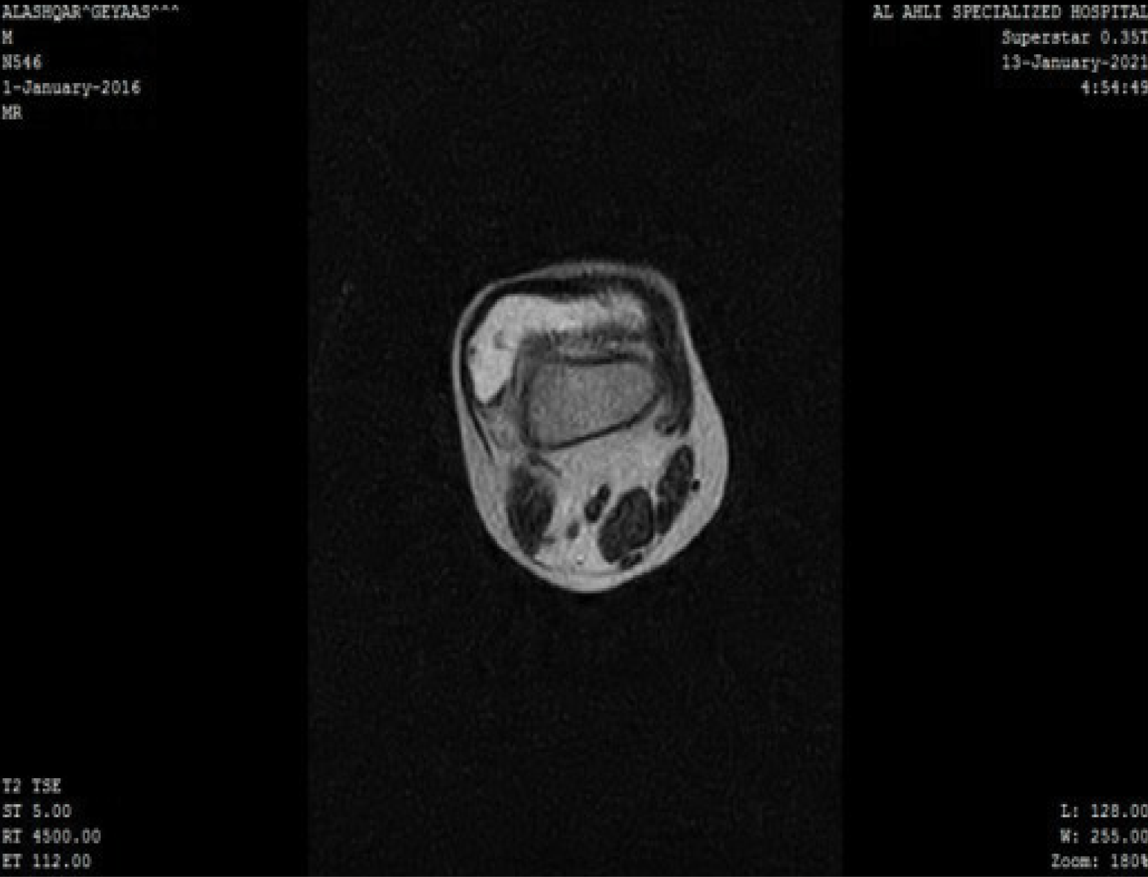 Figure 2: MRI image: Shows large articular effusion on T2-Weighted image with nodular intra-articular masses attached to the synovial membrane.