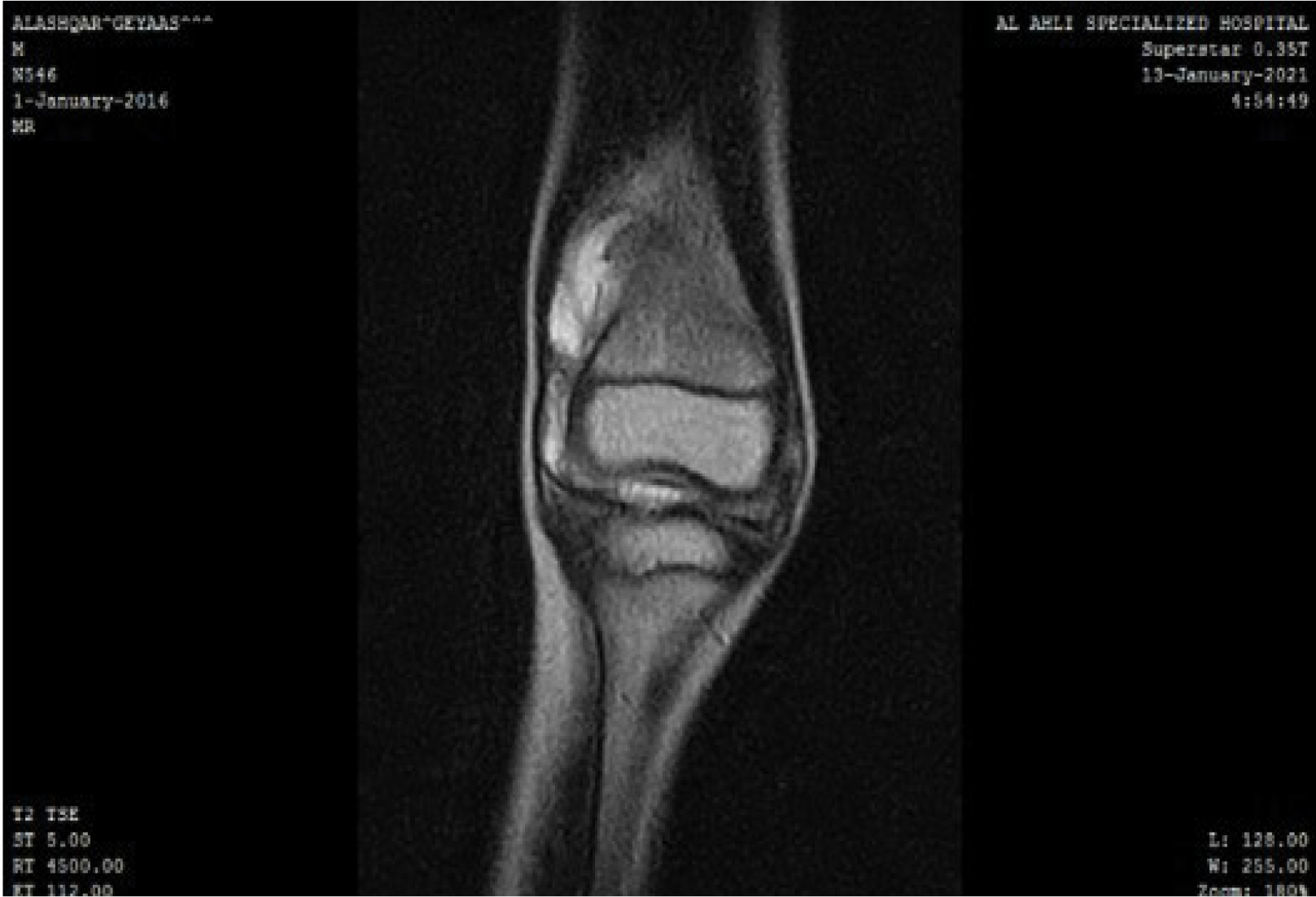 Figure 3: MRI image shows large articular effusion on T2-Weighted image. Figure