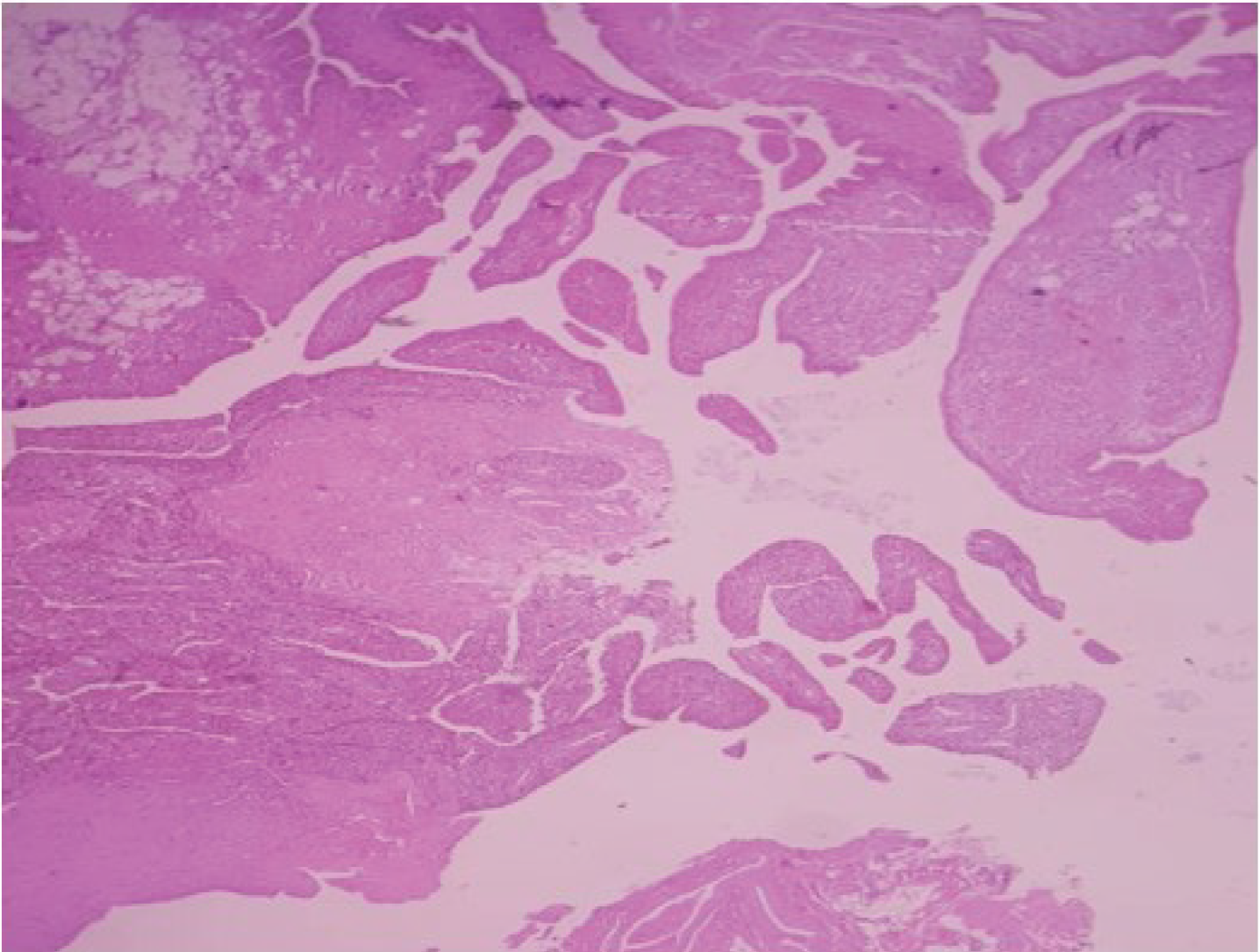 Figure 4: A histologic examination of the synovial membrane shows hyperplastic synovium with papillary projections and mononuclear cells with cleaved nuclei admixed with foamy histiocytic and hemosiderin containing macrophages.